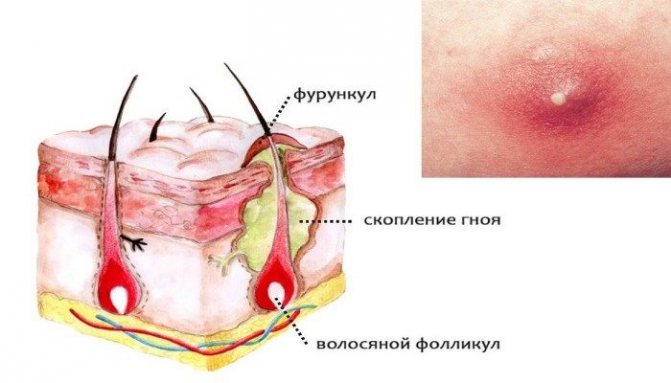 Чирей
