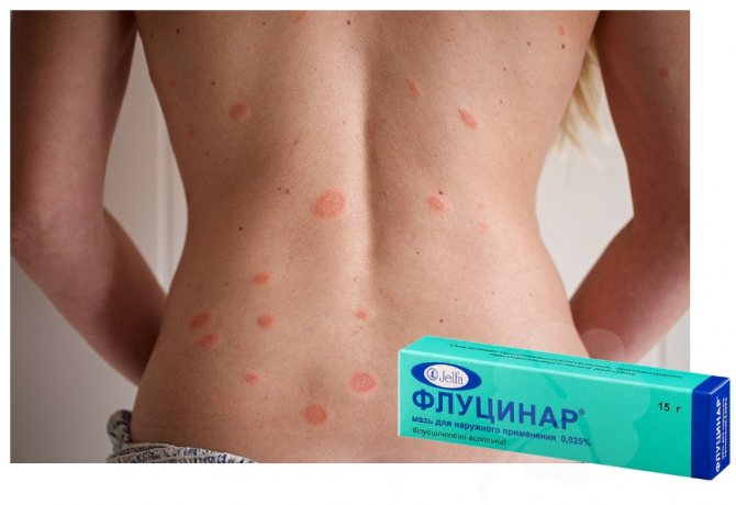 Флуцинар в лечении розового лишая
