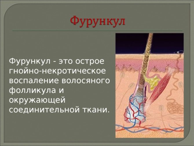 Фурункулы на теле: симптомы, причины и лечение антибиотиками ...