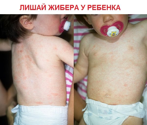 Лишай Жибера у ребенка