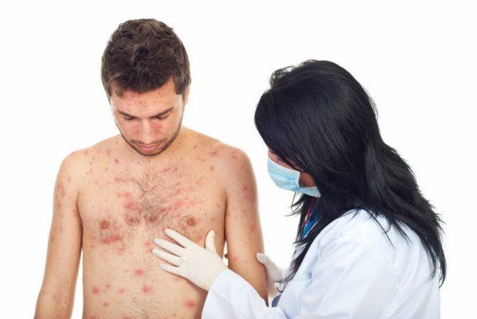 Мазь от лишая: самые эффективные кремы для лечения лишая у человека, противогрибковые и гормональные препараты, средства от лишая при беременности