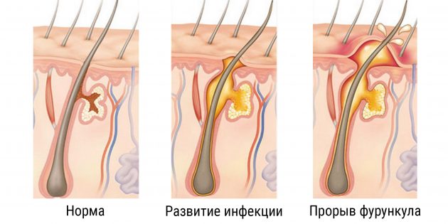 Может ли фурункулез передаваться половым путем