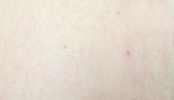 после удаления папилломы сургитроном