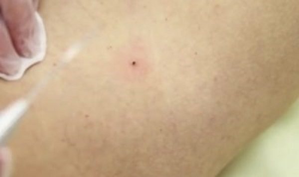 струп после удаления папилломы