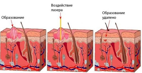 воздействие лазера на папиллому