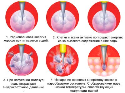 Выбираем лучший метод для удаления новообразований. Что лучше подойдет именно вам: радиоволны или лазер